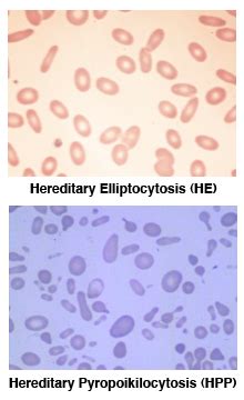 hereditary elliptocytosis life expectancy|Hereditary elliptocytosis and hereditary pyropoikilocytosis.
